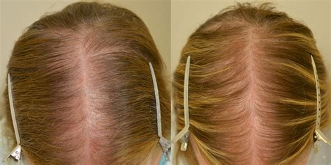 finasteride for women hair loss side effects